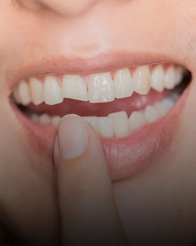 A patient pointing to a broken tooth at the front of their mouth
